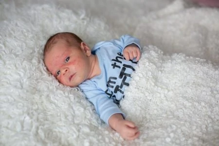 Baby with heat rash on the face