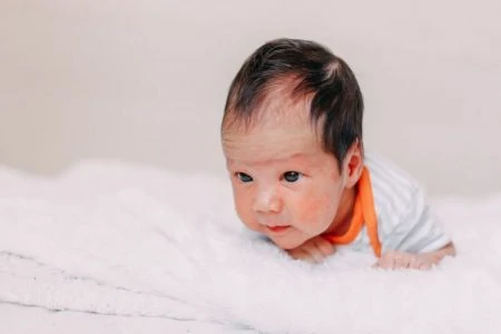 Baby with skin discoloration